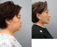 Facelift, Necklift, Rhinoplasty, Genioplasty, Browlift