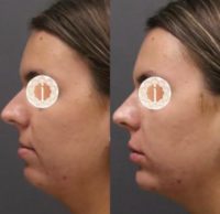 Woman treated with Chin Filler