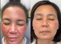 Woman treated with Laser Resurfacing