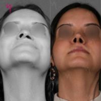 Woman treated with Rhinoplasty