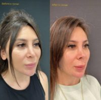 Woman treated with Revision Rhinoplasty